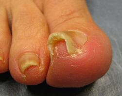 Ingrown Toenail Treatment aka Unguis Incarnatus