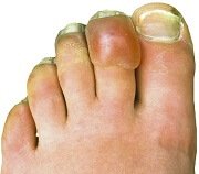 Blisters On Feet & Toes: Causes, Symptoms & Treatment