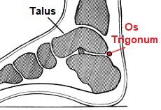 Os Trigonum Syndrome: Causes, Symptoms & Treatment