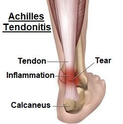 Heel muscles diagram