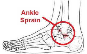 Foot and Ankle Injuries