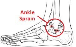 Twisted Ankle: Symptoms, Diagnosis & Treatment