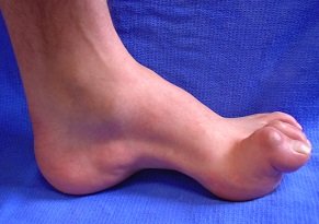 Common Causes of Foot Pain - Foot Pain Explored