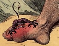 Gout foot is a common cause of toe swelling