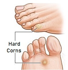 Foot Corns & Calluses: Causes & Treatment - Foot Pain Explored