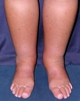 lymphedema of the lower leg and feet.  Note the accentuation of the skin folds around the toes