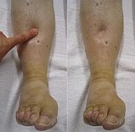 Pitting edema leaves an indentation if you press on the swelling for a few seconds.  It is caused by excess water retention