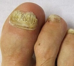 Thick Toenails: Diagnosis & Treatment - Foot Pain Explored